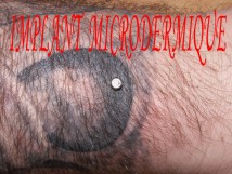 Implant Microdermique