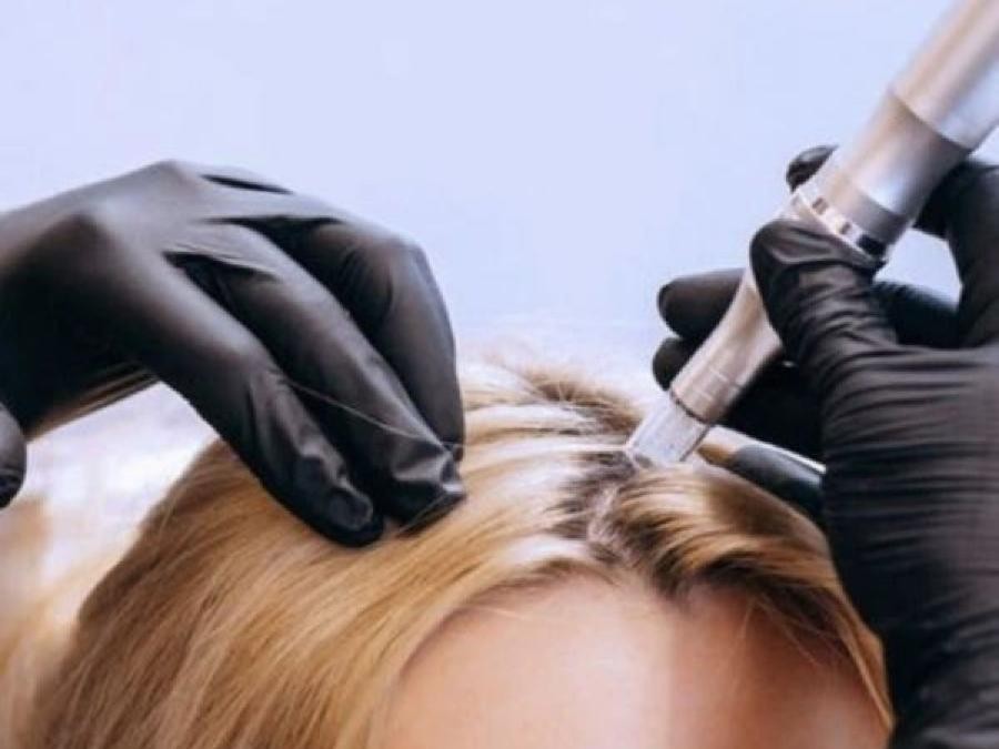 Hairneedling ou Mésothérapie capillaire